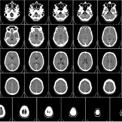 foto ilustracyjne, foto: Autor: Department of Radiology, Uppsala University Hospital, Mikael Häggström